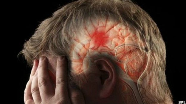 Hemorragia cerebral, Estas son las causas, síntomas y tratamientos.