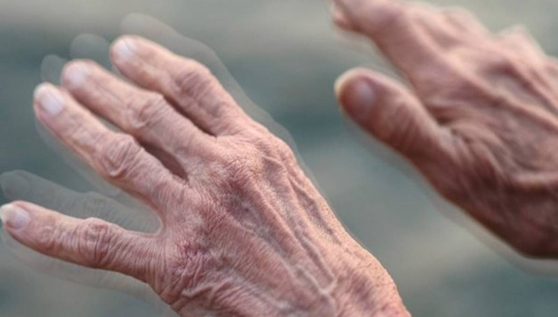 Mal de Parkinson y lo que necesitas saber