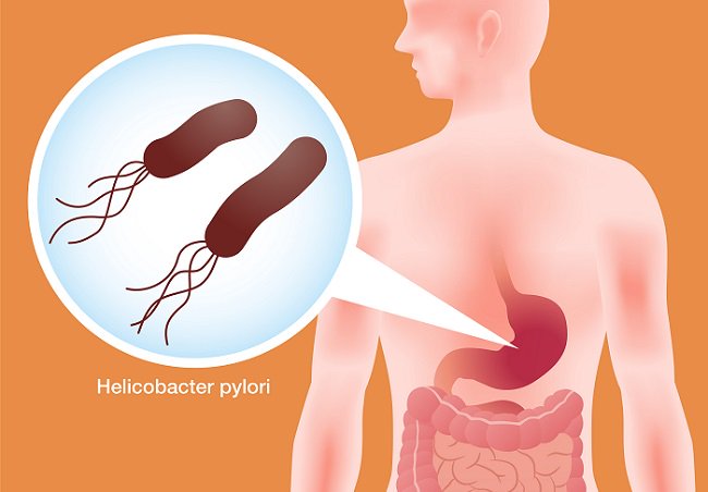Elimina la bacteria Helicobacter Pylori con esta receta