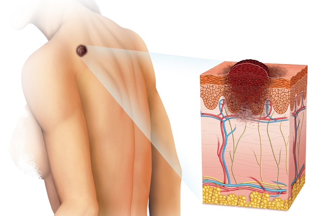 Tipos de cáncer de piel y cómo detectarlos