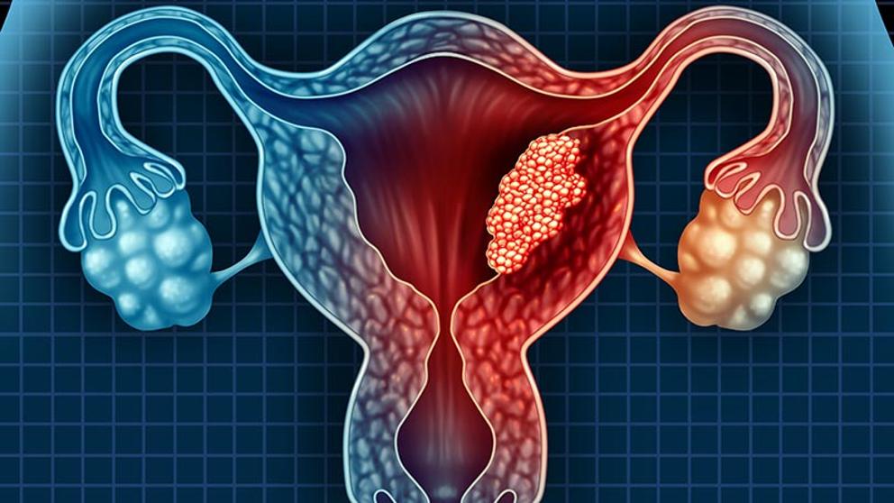 Tipos de cáncer de ovario: síntomas, causas, estadios y tratamiento