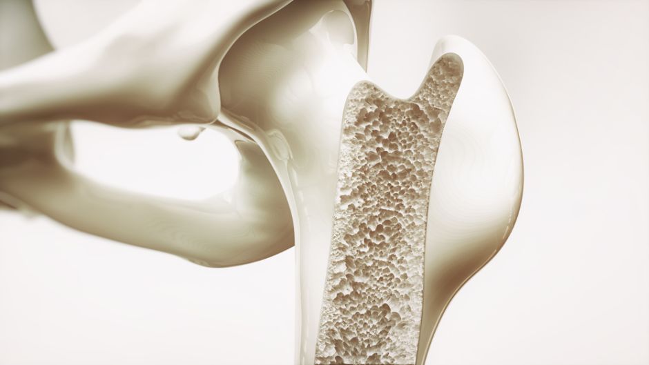 2 signos mas importantes de que padeces osteoporosis
