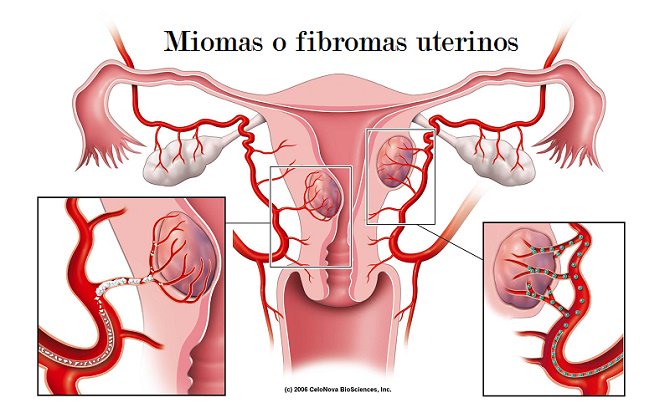 7 señales de advertencia de miomas uterinos