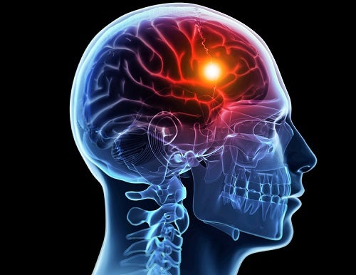 Todo sobre: Infarto cerebral; las causas y tratamiento