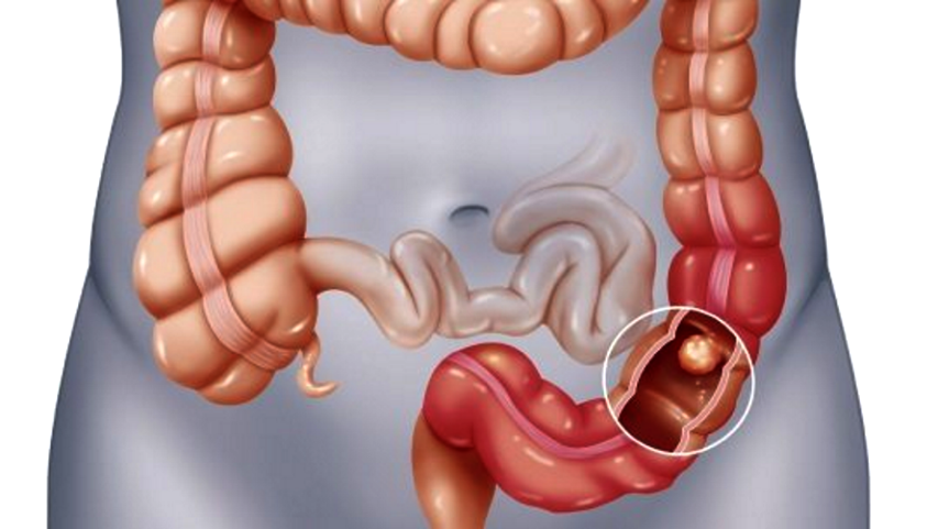 Síntomas de cáncer de colon que no debes ignorar