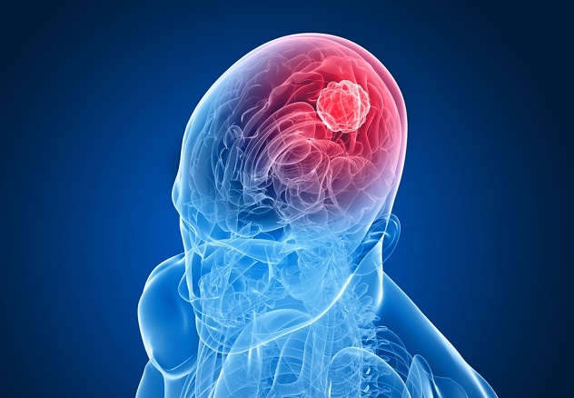 9 signos tempranos de cáncer cerebral