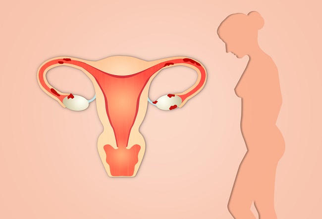 Los síntomas de la endometriosis que debes conocer