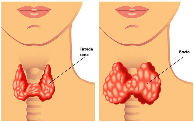 5 hábitos que alteran tu tiroides