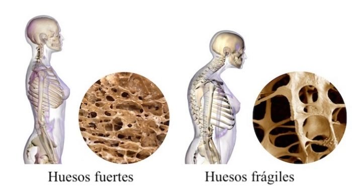 Tratamiento para la osteoporosis, 7 maneras de aumentar la densidad ósea