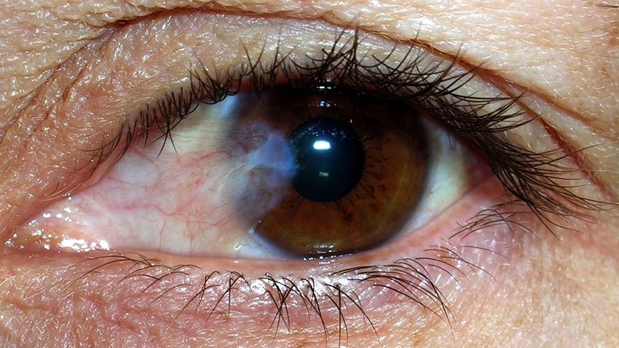 Qué es el glaucoma y cómo tratarlo naturalmente