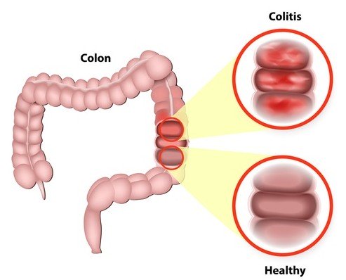 Remedios populares para colon inflamado