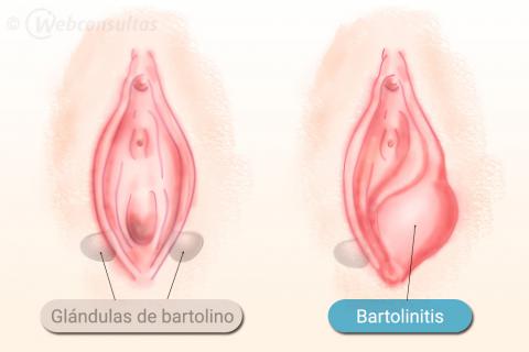 Quiste de Bartolino en la zona intima y cómo tratarlo adecuadamente