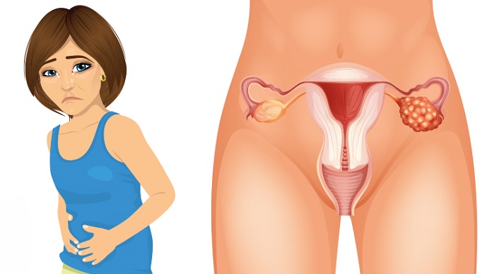 10 señales tempranas de cáncer de ovario que no debes ignorar
