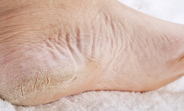 Aprende a deshacerte de los pies secos con remedios naturales