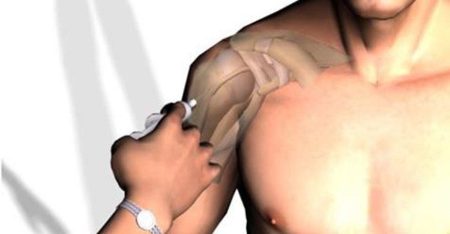 ¿Padeces dolor en tu hombro? Se llama tendinitis y aquí te indicamos cómo mejorarlo al instante