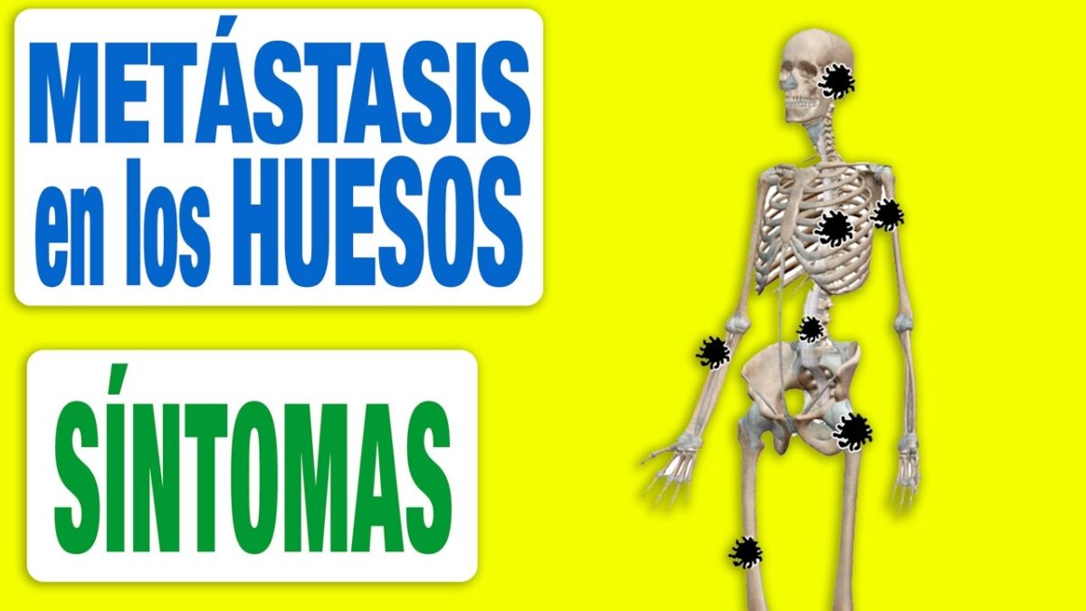 Metástasis en los huesos: síntomas y tratamientos