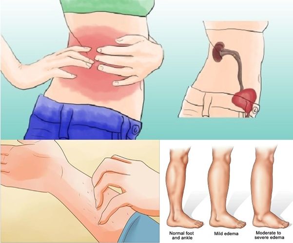 8 Síntomas que indican que tienes problemas en los riñones