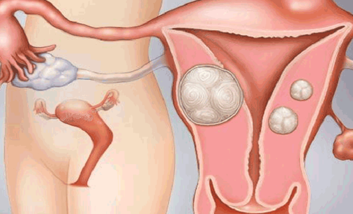 Maneras de cuidar el útero para tener mejores ciclos menstruales