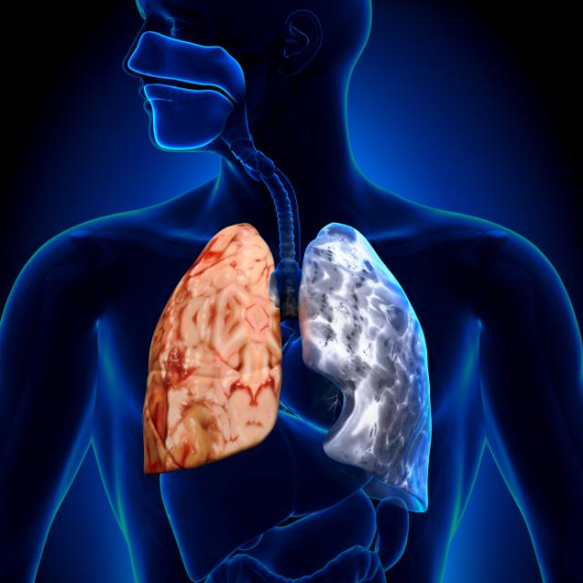 Alimentos que revierten la enfermedad pulmonar obstructiva crónica