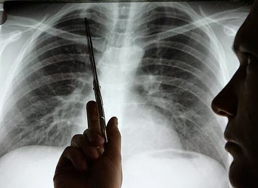 7 señales de cáncer de pulmón que no debes ignorar