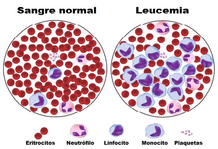 6 signos de leucemia que toda mujer debe saber