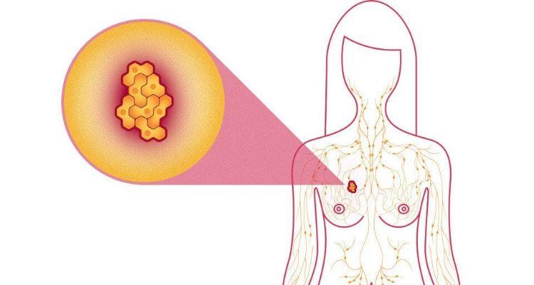 Riesgo de cáncer de seno y siete maneras de disminuirlo