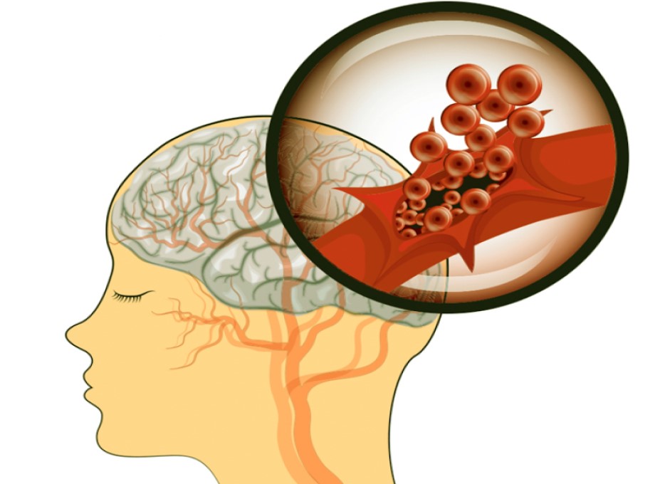 Prevenga un derrame cerebral: 15 síntomas de apoplejía que nunca hay que pasar por alto