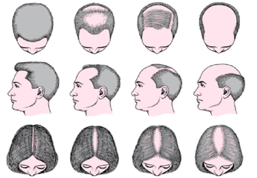 15 Remedios naturales para la alopecia Areata (pérdida de cabello)